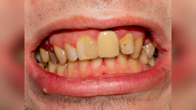 दांतों में काले कीड़ों से छुटकारा दिलाती हैं ये 6 चीजें, पायरिया की तकलीफ भी होगी दूर