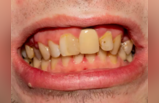 Yellow Teeth: एका रात्रीत दातांचा पिवळाधम्मक थर होईल दूर, काळी कीड व पायोरिया होईल सेकंदात गायब, करा हे 6 उपाय