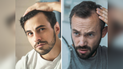 Male Baldness: या विचित्र कारणांनी पुरुषांना पडते टक्कल, वेळेत करा हे काम, डोक्यावरचा एकही केस गळणार नाही