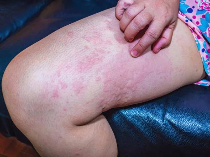 skin rashes allergy hives