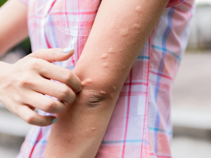 skin rashes allergy hives (2)