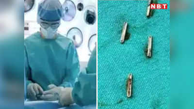 हे भगवान! पित्त की थैली से निकली 5 सर्जरी क्लिप, पांच साल पहले ऑपरेशन में डॉक्टरों ने छोड़ दिया था