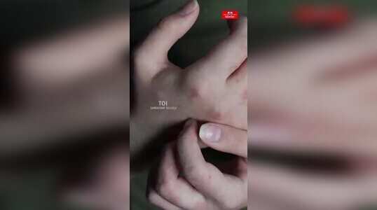 చర్మంపై వచ్చే బొబ్బలు తగ్గేందుకు టిప్స్