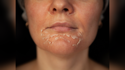 Peeling Skin: अचानक सांप की तरह झड़ने लगती है त्‍वचा? ये हो सकते हैं 6 कारण