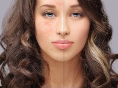 पिगमेंटेशनमुळे चेहरा पडतोय का काळा? जाणून घ्या कारणे आणि त्यावरील उपचार