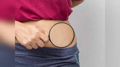 Stretch Marks: ఈ నూనె రాస్తే స్ట్రెచ్ మార్క్స్ తగ్గుతాయట.. 