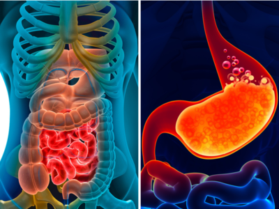 जिसे आप मामूली Acidity समझ रहे, वो पेट का कैंसर तो नहीं? ये 6 लक्षण दिखते ही भाग पड़ें डॉक्टर के पास