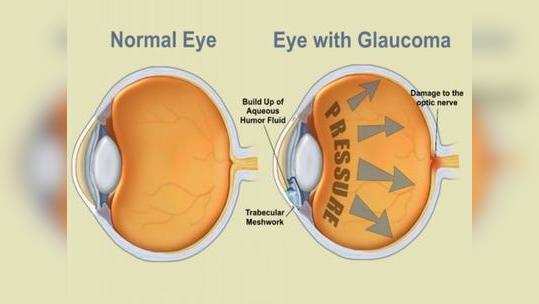 நீரிழிவு நோயாளிகளுக்கு கிளைக்கோமா வந்தால் எப்படி இருக்கும்? பார்வை பறிபோகாமல் எப்படி தவிர்க்கலாம்?...