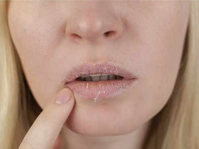 Lip Care in Winter: শুষ্ক আবহাওয়ায় ঠোঁট ফেটে চৌচির? এসব ঘরোয়া উপায়ে সামাল দিন