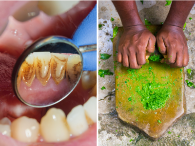 Teeth Whitening Remedies: ब्रश करने के बाद भी पीले होकर सड़ रहे दांत? जिद्दी टार्टर को उखाड़ फेंकेंगे 4 मसाले