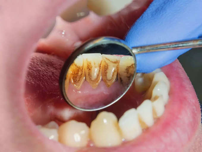 दांतों पर टार्टर या प्लैक जमने के लक्षण