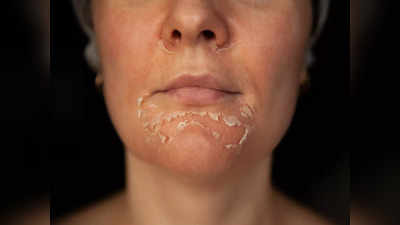 Peeling Skin Causes: ক্রিম-ভেসলিন লাগিয়েও মুখ, হাত-পা থেকে খোসার মত চামড়া উঠছে? স্ট্রেস বাড়াবেন না, সমাধান রয়েছে হাতের কাছেই