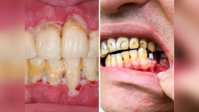 दातावर रगडा घरातील जेलीमय पदार्थ कीड होईल नष्ट, पिवळेपणाचा थर आणि Cavity ला ठोका रामराम