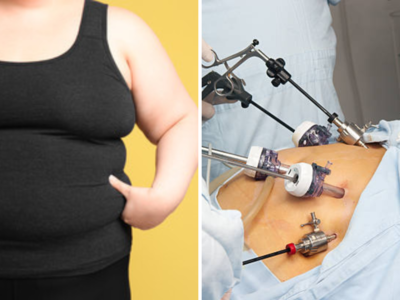 लठ्ठपणापासून मुक्तता: बॅरिएट्रिक सर्जरी नेमकी केव्हा करावी? तज्ज्ञांचा सल्ला