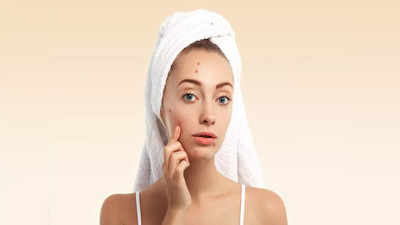 Causes For Pimples: నిద్రపోయేప్పుడు ఈ పొరపాట్లు చేస్తే.. మొటిమలు వస్తాయ్‌..!