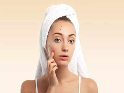 Causes For Pimples: నిద్రపోయేప్పుడు ఈ పొరపాట్లు చేస్తే.. మొటిమలు వస్తాయ్‌..!