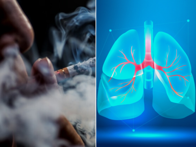 Lung Cancer: સ્મોકિંગની લત નહીં હોવા છતાં આ ટીવી એક્ટ્રેસને થયું ફેફસાનું કેન્સર, Dr.એ જણાવ્યા આ બીમારીના 5 કારણો 