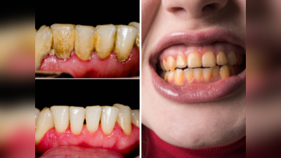 पिवळ्याधम्मक दातावरील चमक येईल ५ मिनिटात परत, पाच पद्धतीने काढा पिवळा थर मिळवा सफेद दात