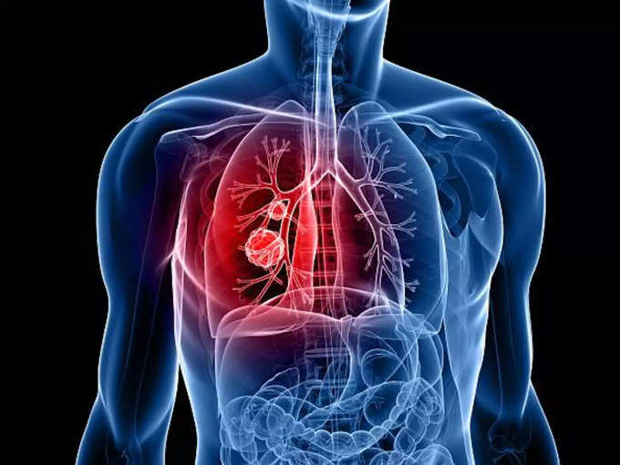 ​கோவிட் நிமோனியா என்றால் என்ன? (What is COVID pneumonia)