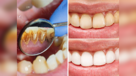 Remedy For Yellow Teeth: दातांवरील पिवळा थर काही क्षणात होईल दूर, मोत्यांसारखे चमकतील दात 