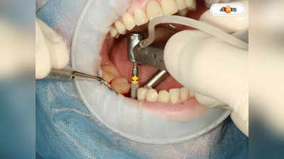Dental Surgery: এক ভিজিটে ৪টি রুট ক্যানেল! ৩০ বার ছুরি-কাঁচির খোঁচা খেয়ে ডেন্টিস্টের বিরুদ্ধে মামলা রোগীর