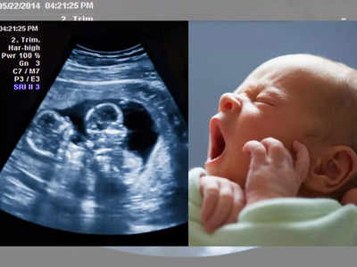 गर्भात जुळी, अल्ट्रासाऊंडमध्येही दिसली, पण जन्माला आलं एकच बाळ; रुग्णालयात खळबळ