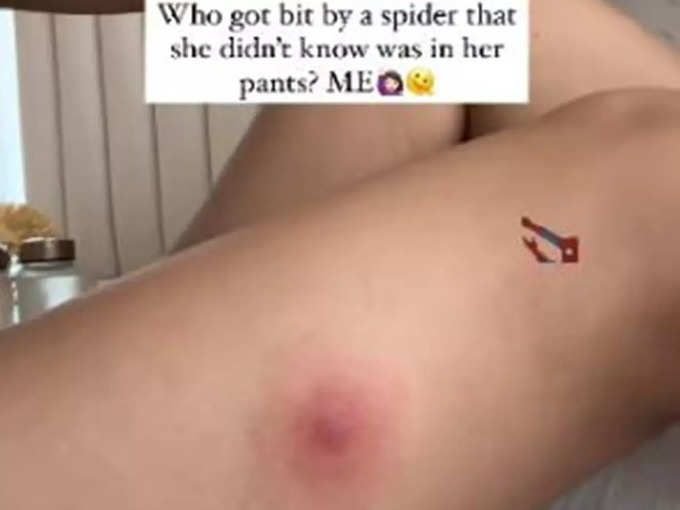 Alaya F Spider Bite