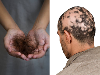 केस विंचरल्यावर गुच्छा येतोय हातात असू शकतो गंभीर आजार, टक्कल पडण्याचा कोणाला आहे धोका