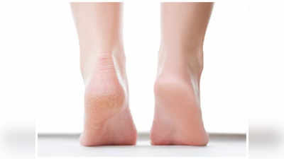 Cracked Heels: కాలిపగుళ్ళు తగ్గాలంటే వీటిని రాయండి..