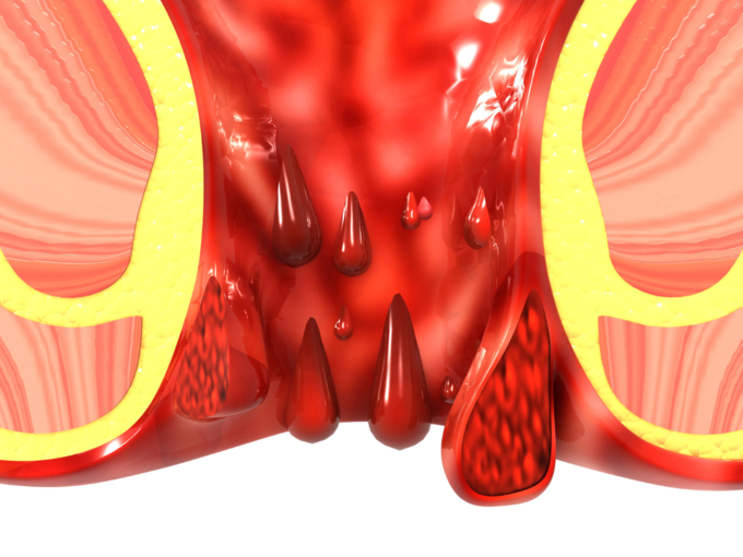 piles hemorrhoids bleeding (3)