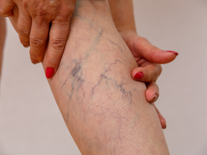 varicose veins leg problem