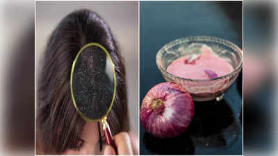Onion For Dandruff: শীতে মাথায় ভরে যায় খুশকি, সারাক্ষণ চুলকায়? পেঁয়াজের সঙ্গে এই উপাদান মিশিয়ে মাত্র ১ দিন লাগান