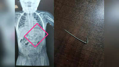 Pin in Babys Stomach: പിഞ്ചുകുഞ്ഞിന്‍റെ വയറ്റില്‍ തുറന്ന പിന്ന്, വിട്ടുമാറാത്ത വയറുവേദന; വിജയകരമായി പുറത്തെടുത്ത് ഡോക്ടര്‍മാര്‍