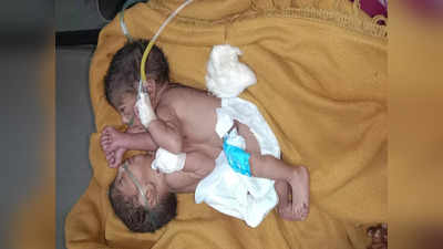 Sagar News: कुदरत का करिश्मा: दो जिस्मों में धड़क रहा एक दिल, सागर में जन्मीं अनोखी जुड़वां बच्चियां