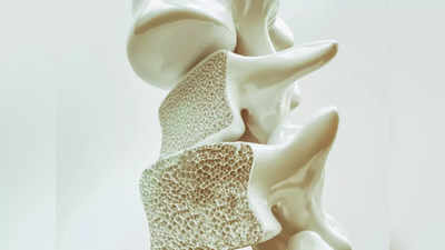 Osteoporosis: ఈ అలవాట్లు వల్ల ఎముకలు బలహీనంగా మారి.. ఆస్టియోపోరోసిస్‌ ముప్పు పెరుగుతుంది..!