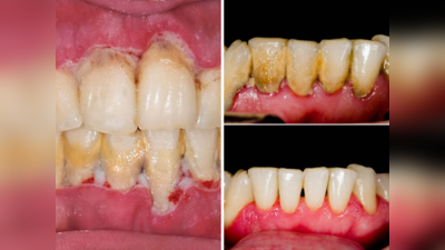 दातांवरील पिवळा थर दूर करण्यासाठी ५ घरगुती उपाय, मोत्यासारखे शुभ्र चमकतील दात