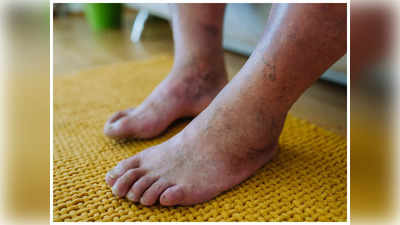 Diabetic Foot: డయాబెటిక్ ఫుట్ అంటే ఏంటి? లక్షణాలు ఎలా ఉంటాయి..