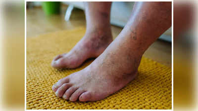 Diabetic Foot: డయాబెటిక్ ఫుట్ అంటే ఏంటి? లక్షణాలు ఎలా ఉంటాయి.. 