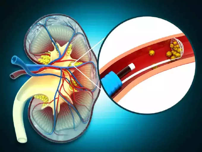 சிறுநீரகக் கற்கள்  அறிகுறிகள்