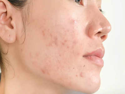 Acne scars home remedies: మొటిమల మచ్చలు తగ్గట్లేదా..? తులసిలో ఇది మిక్స్‌ చేస్తే మాయం అవుతాయ్‌..!