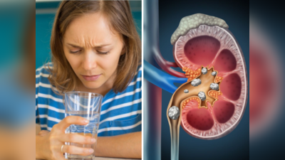 Kidney Stones Causes: कम ही नहीं, गर्म पानी पीना भी खतरनाक, किडनी में बन जाएंगी मोटी-मोटी पथरी