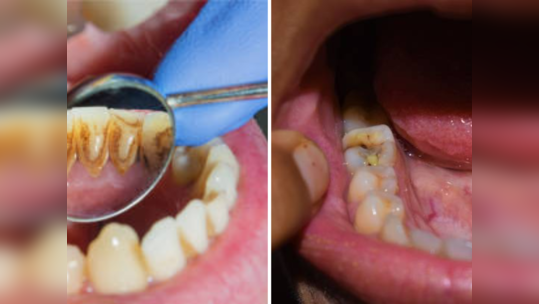 Teeth Whitening Tips: पिवळे दात एका वॉशमध्ये होतील पांढ...                                         