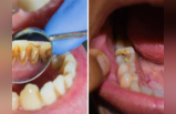 Teeth Whitening Tips: पिवळे दात एका वॉशमध्ये होतील पांढरे शुभ्र, या घरगुती उपायांनी अंधारातही चमकू लागतील दात