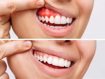 Gingivitis: చిగుళ్ల వాపు వేధిస్తోందా..? ఈ సింపుల్ చిట్కాలు ఫాలో అయితే త్వరగా తగ్గుతుంది..!