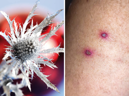 Alaskapox Virus ने गेला अमेरिकेत जीव, जाणून घ्या किती गंभीर आहे आजार आणि लक्षणे