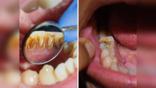 गुटखा खाऊन झालेले लाल पिवळे दात क्षणात करा साफ, या उपायाने अंधारातही चमकतील दात 