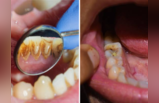 गुटखा खाऊन झालेले लाल पिवळे दात क्षणात करा साफ, या उपायाने अंधारातही चमकतील दात