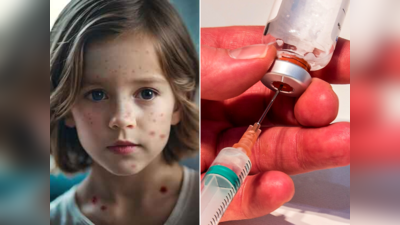 Measles: MPમાં આ શંકાસ્પદ ચેપી બીમારીથી 2 બાળકોના મોત, આ લક્ષણો જોવા મળે તો તત્કાળ લો ડોક્ટરની સલાહ- WHO