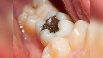 Tooth Cavities : दांतों की कैविटी से बचना है तो इन 5 बातों का रखें ध्यान