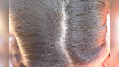 Hair Oiling Side Effects: খুশকি তাড়াতে গিয়ে করলে এই ভুল কাজ, চুল উঠে পড়বে টাক!